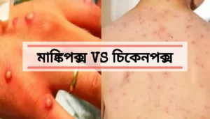 মাঙ্কিপক্স এবং চিকেনপক্সের মধ্যে পার্থক্য কী?